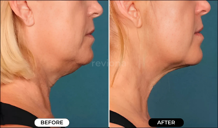 NeckLift Instant Tape