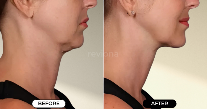 NeckLift Instant Tape