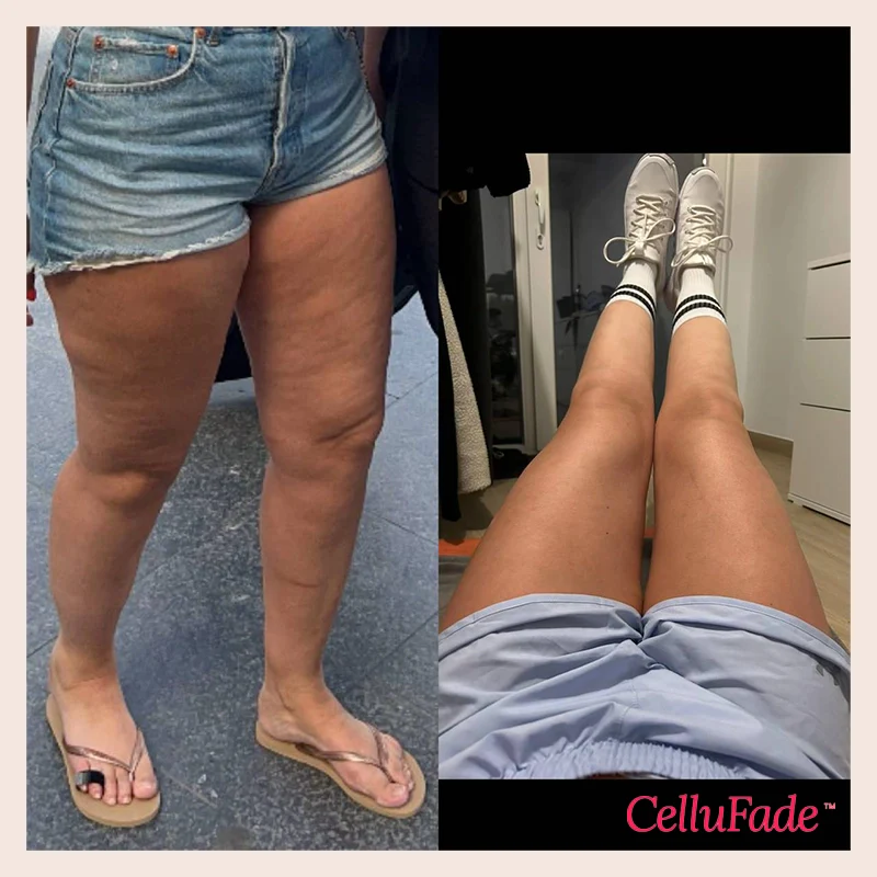 SmoothSkin Cellulite Roller