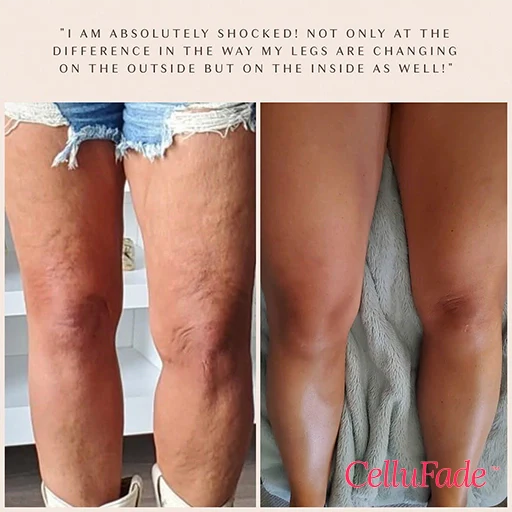 SmoothSkin Cellulite Roller