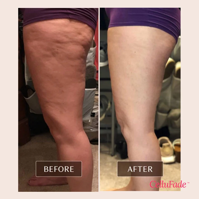 SmoothSkin Cellulite Roller